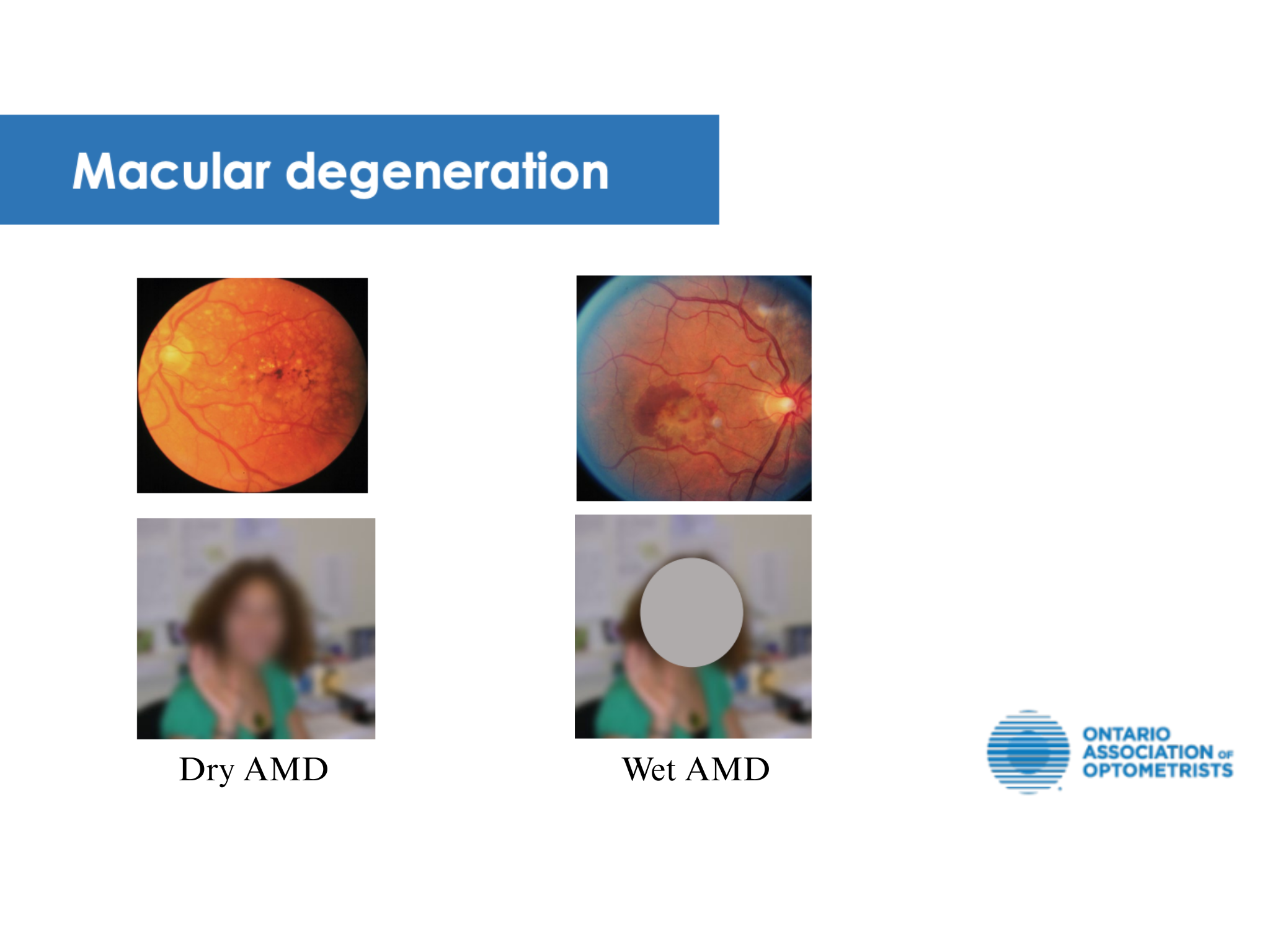 Macular Degeneration Management Macular Degeneration Management