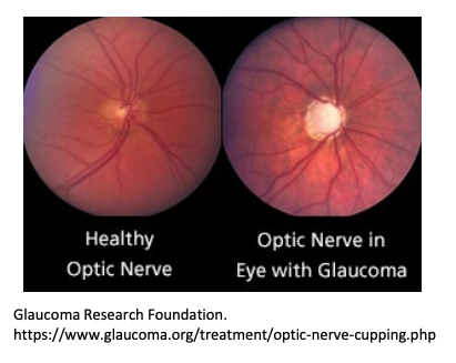 Glaucoma Management Glaucoma Management